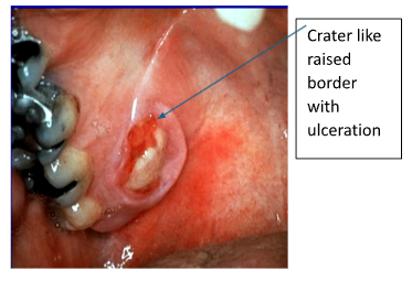 <p>Indurated (hard) and ulcerated swelling</p><p>Usually on palate</p><p>Benign inflammatory disease</p><p>Heals after 4-8 weeks</p>