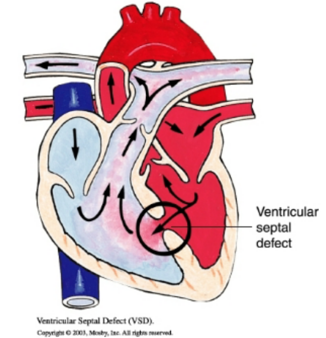 <p>oxygenated blood from the left ventricle to the right ventricle and lungs, loud and harsh systolic murmur, large defects can cause Eisenmenger syndrome and require surgical closure, acyanotic</p>