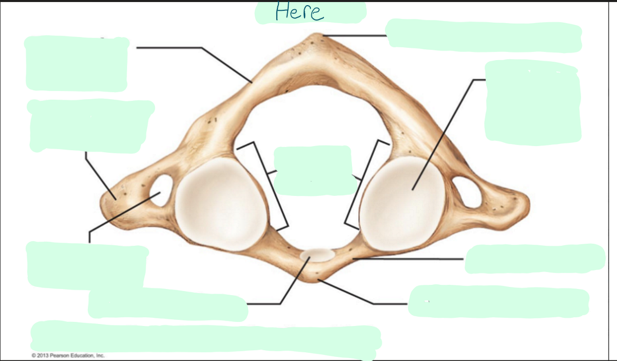 <p>Where is the transverse foramen of the atlas?</p>