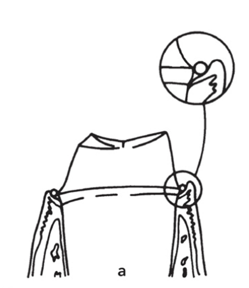 <p>Is the placement of this retraction cord in the sulcus acceptable?</p>