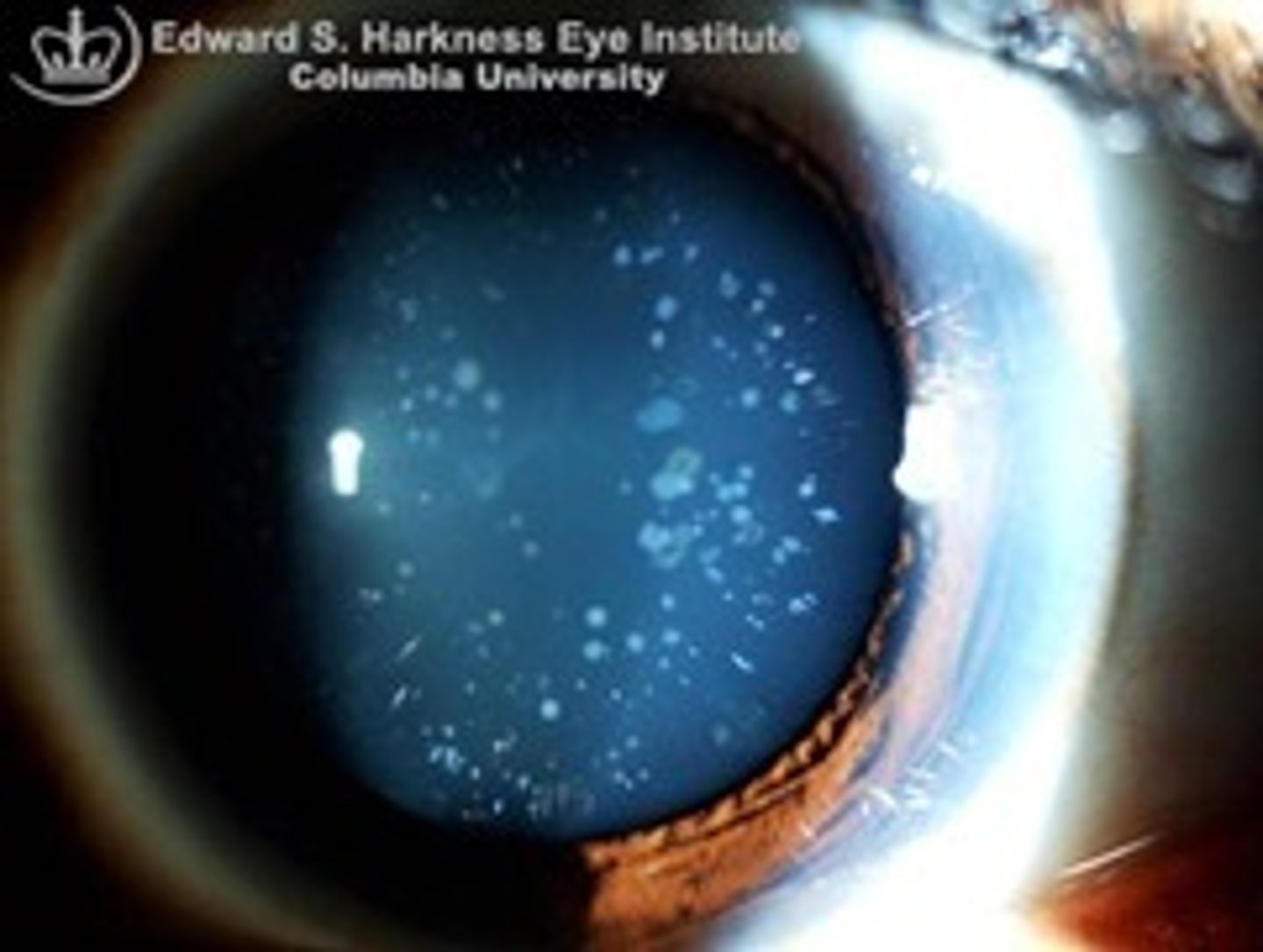 <p>Cerulean cataract</p>