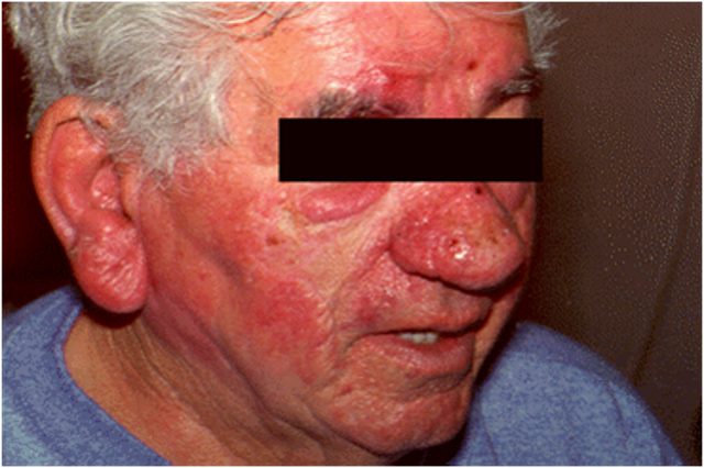 <p>condition causing development of large, bulbous nose associated with granulomatous infiltration, commonly due to untreated rosacea </p>