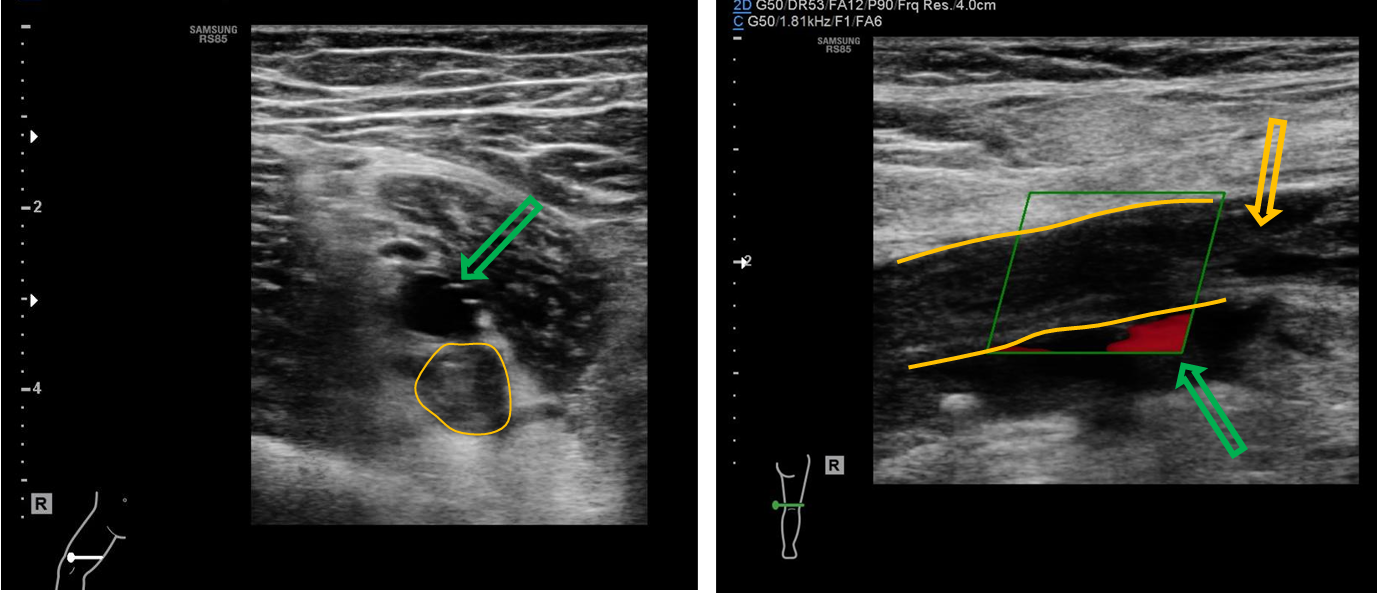<p>Patient history: calf pain and swelling of the right leg, plaster cast due to trauma in recent weeks</p><p> Modality: Lower extremity venous ultrasound, linear probe (7,5-10 MHz), B-mode and Color-Doppler mode (right panel) </p><p>Region: femoral superficial and popliteal veins; left image – transverse section, right image – sagittal section </p><p>Radiologic sign: Veins are filled with hypoechoic thrombus (yellow lines and arrow); the lumen is non-compressible demonstrating no flow (lack of Doppler-signal); beneath the popliteal artery has normal flow signal (green arrow). </p><p>Diagnosis: deep vein thrombosis (DVT)</p>