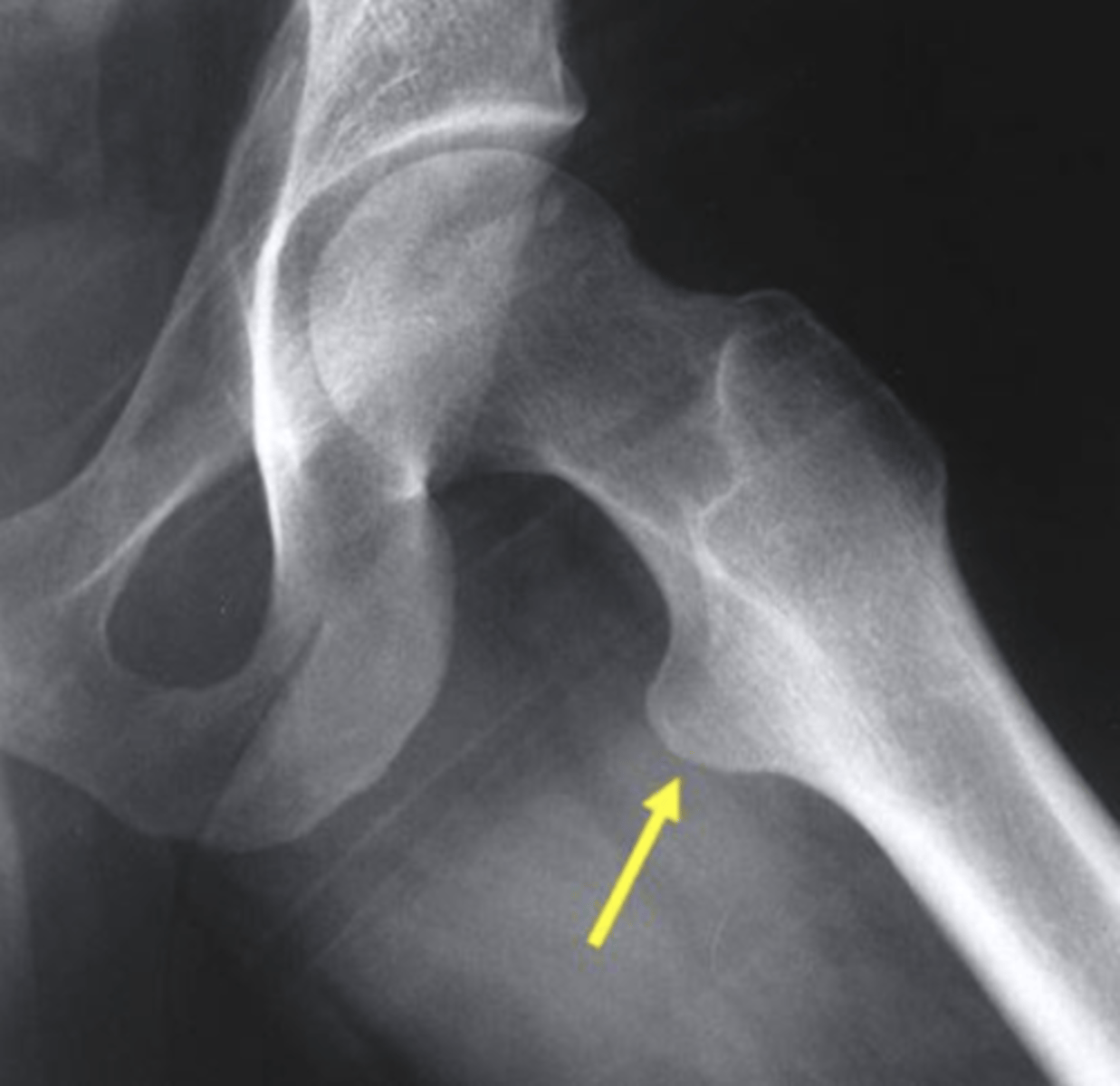 <p>lesser trochanter</p><p>3 multiple choice options</p>