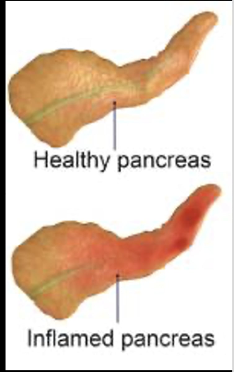 <p>Inflammation of the pancreas</p><p>Associated with several other clinical disorders</p><p>-- Caused by an injury or damage to pancreatic cells and ducts, causing a leakage of pancreatic enzymes into the pancreatic tissue</p><p>These enzymes cause auto-digestion of pancreatic tissue and leak into the bloodstream to cause injury to blood vessels and other organs</p>