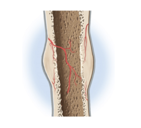 <p>Small bone fragments are removed by osteoclasts, while osteoblasts deposit spongy bone and then convert it to compact bone</p><ul><li><p>where bone has been broken, compact bone replaces it</p></li><li><p>your bone becomes stronger after breaking it </p></li></ul><p></p>