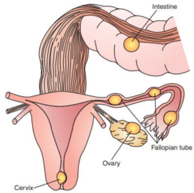 <p>pregnancy occurs when a fertilized</p><p>egg implants outside the uterine cavity, most</p><p>commonly in the fallopian tube (in approximately 95% of such pregnancies). 80% occur in the ampullar portion, 12% occur in the isthmus, and 8% are interstitial or fimbrial. Less frequent sit include the ovary, abdominal cavity, or cervix. It is a life-threatening condition requiring immediate medical attention.</p>