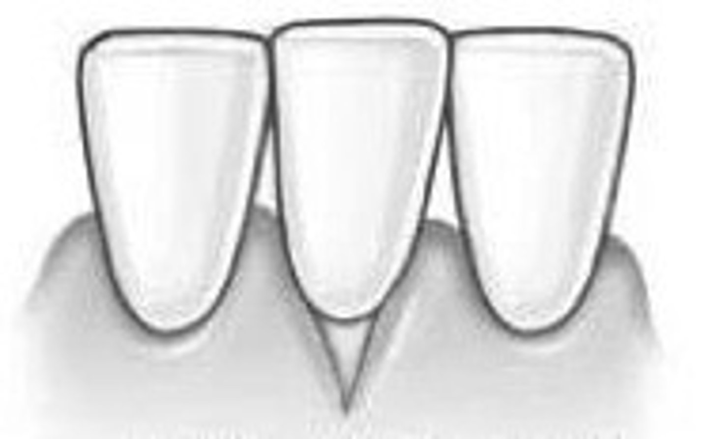 <p>localised recession that is a v shape</p>