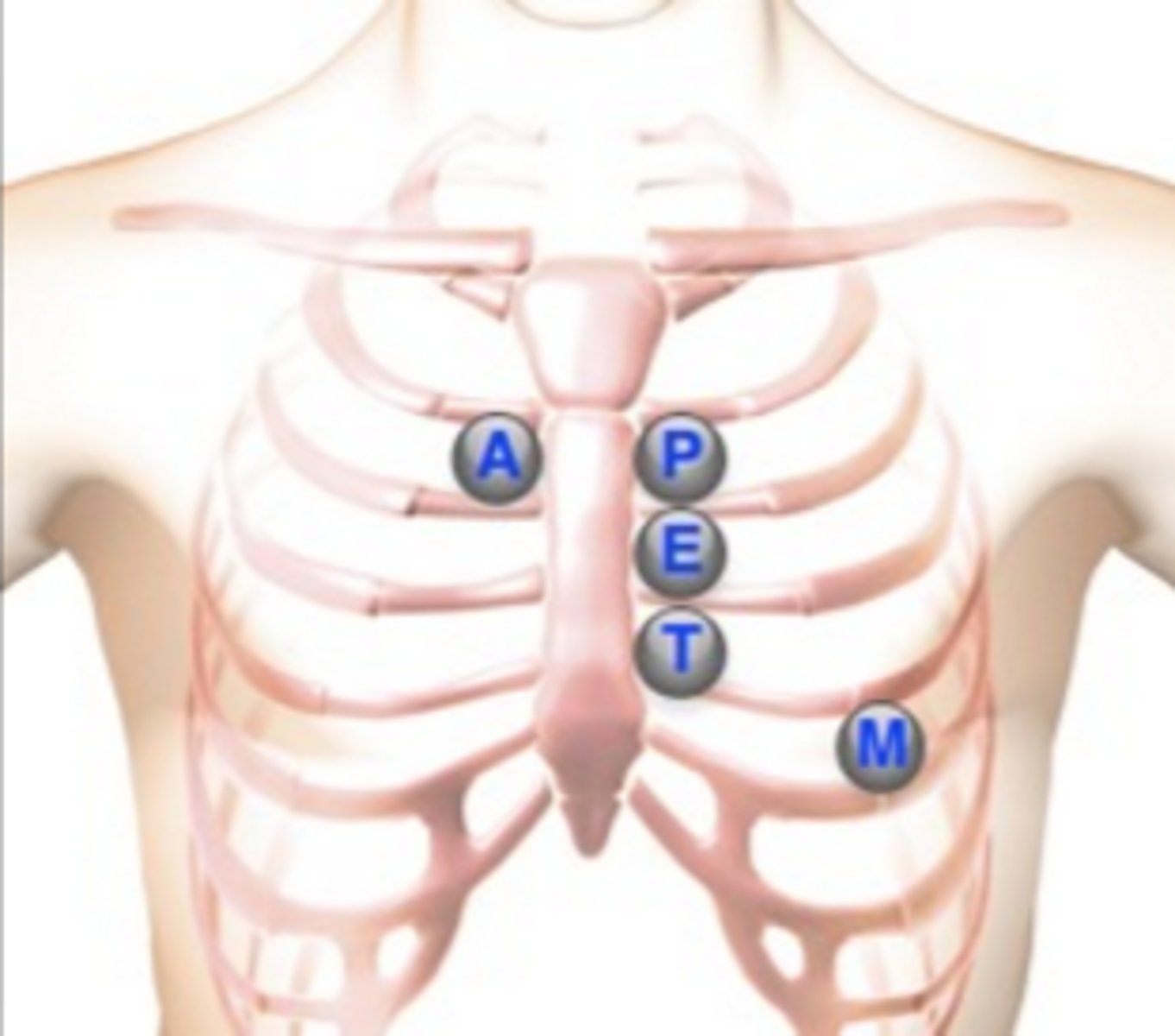 <p>5th intercostal space, left midclavicular line (apical pulse)</p>