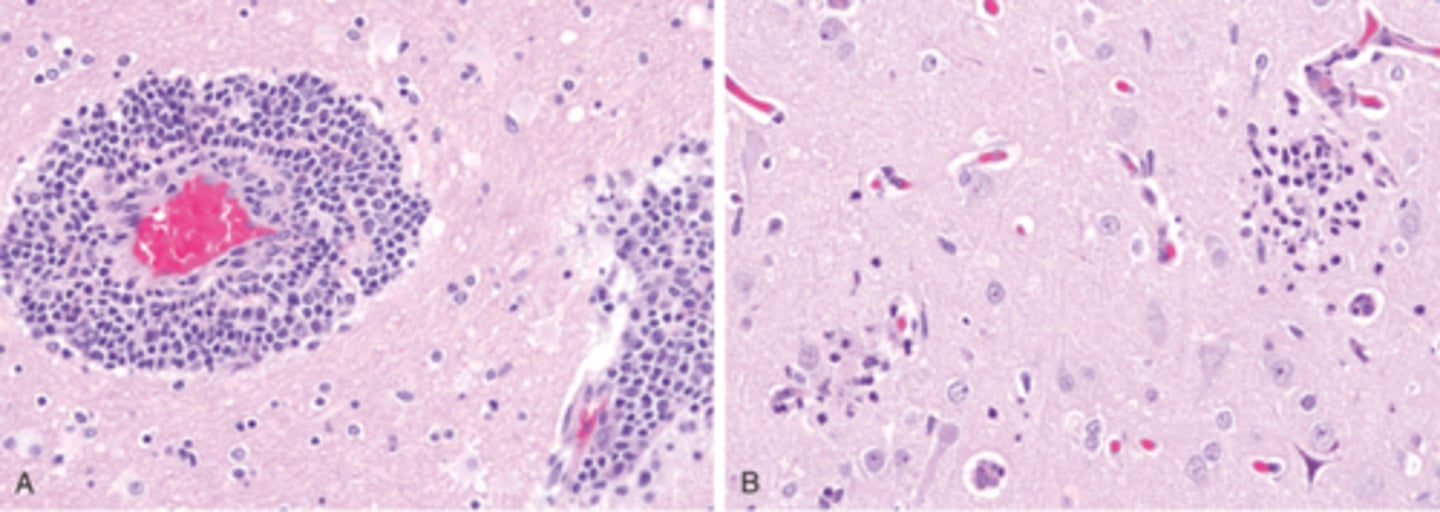 <p>What are the hallmarks for Viral Meningoencephalitis?</p>