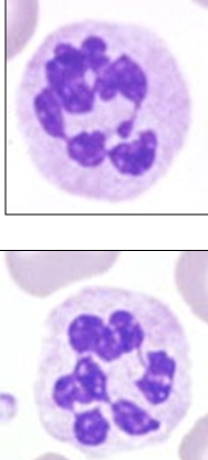 * More nuclear segmentation 


* Not v significant clinically
  * Aging
  * Old blood sample
* A result of increased circulation time
  * Coritcosteroids
  * others