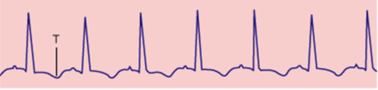 <p>inverted T wave</p>