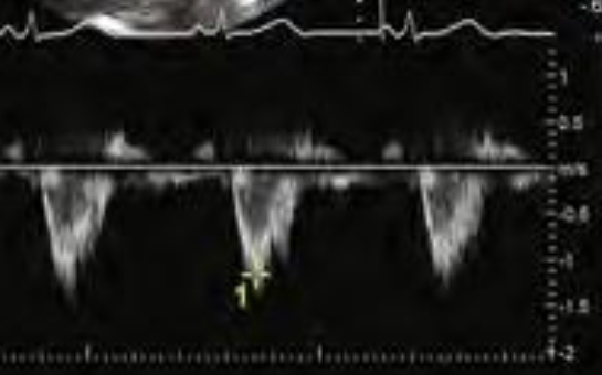 <p>Describe this trace in terms of:</p><ul><li><p>modality</p></li><li><p>quality of flow</p></li><li><p>peak velocity</p></li><li><p>shape of the flow</p></li><li><p>what is being measured</p></li></ul><p></p>
