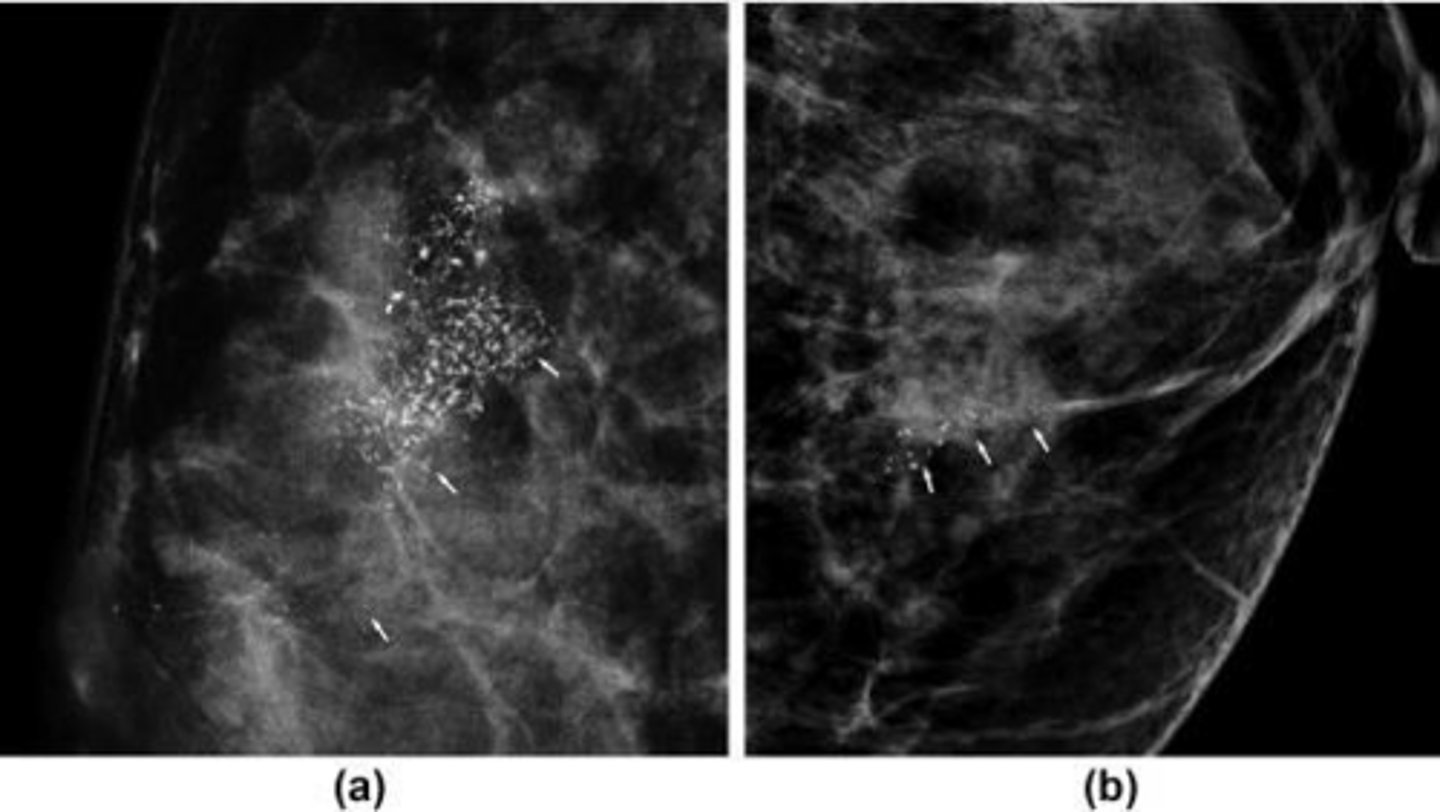<p>As clustered microcalcifications.</p>