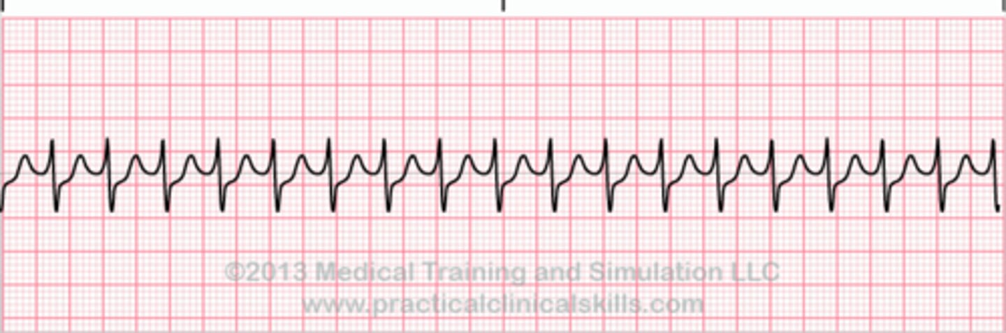 <p>sudden fast regular rhythm</p><p>causes: stress, hypoxia, and metabolic disorders</p><p>often in healthy hearts</p><p>s/s palpitations, dizziness, decreased CO if sustained</p><p>tx: first line vagal maneuvers</p><p>second: beta blockers, calcium channel blockers, or adenosine</p><p>third: cardioversion if unstable</p>