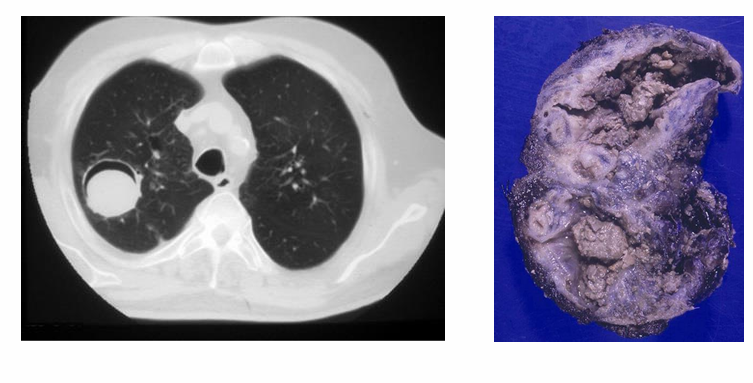 <p>-fungal balls in larger lung cavity or sinuses</p><p>-may be asymptomatic or present with cough, wheeze, fatigue</p>