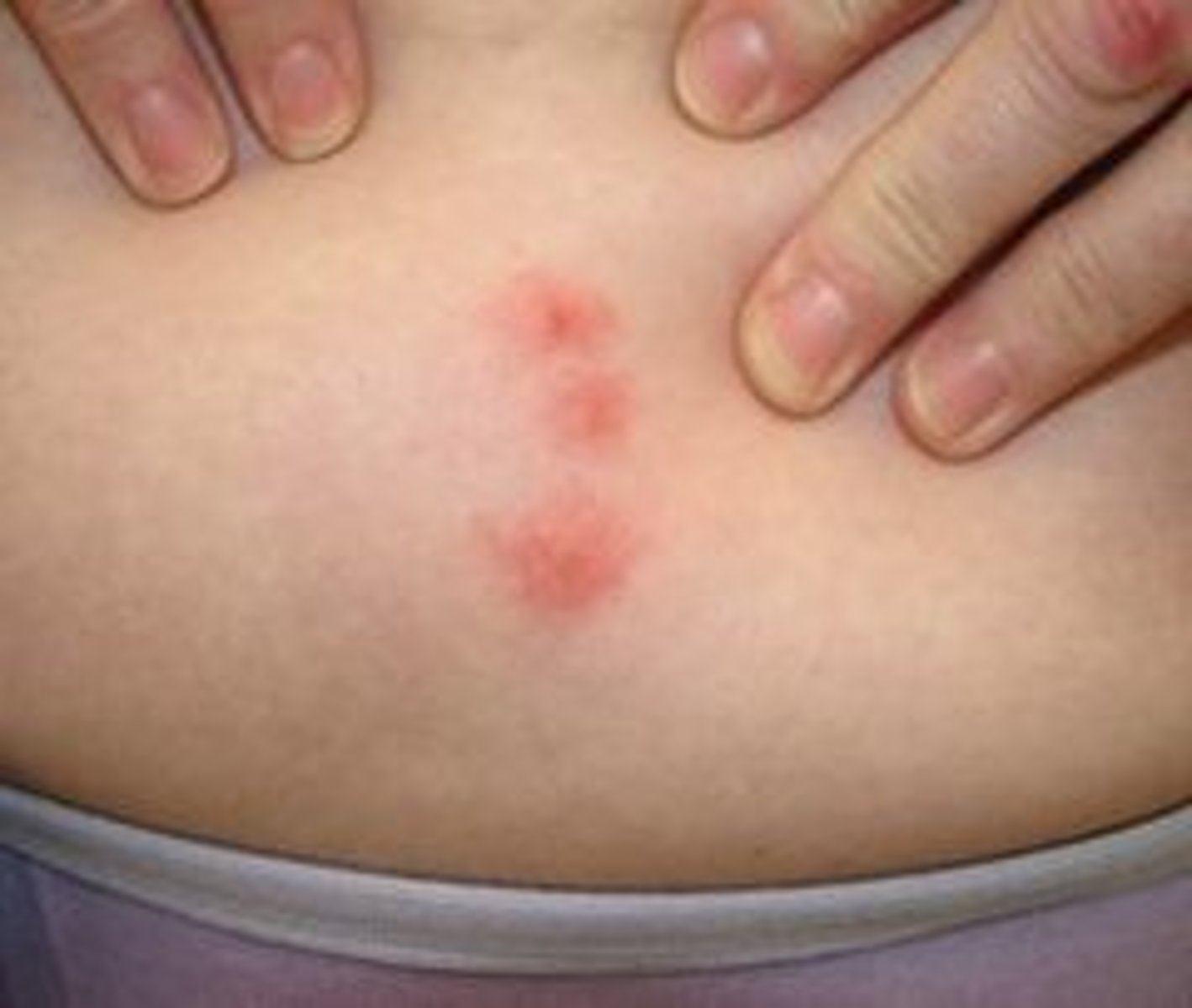 <p>pruritic (itchy), erythematous wheal</p>