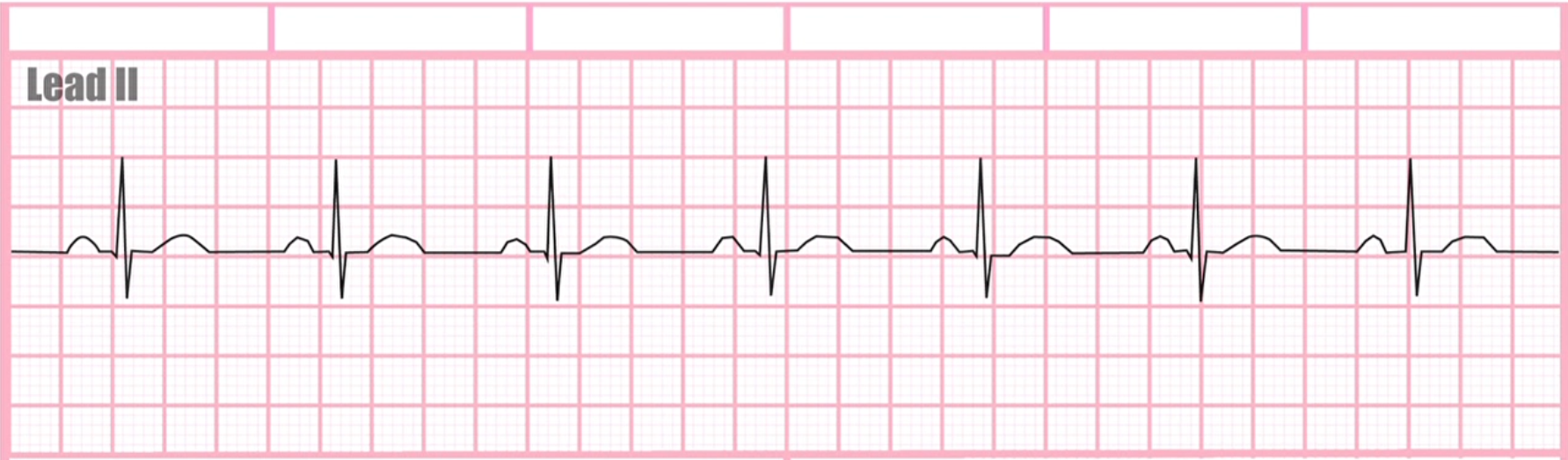 <p>What does this EKG represent?</p>
