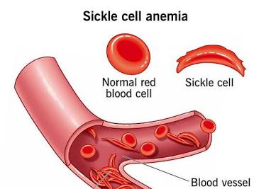 <p>blood disorder passed down to offspring where red blood cells become crescent shaped </p>