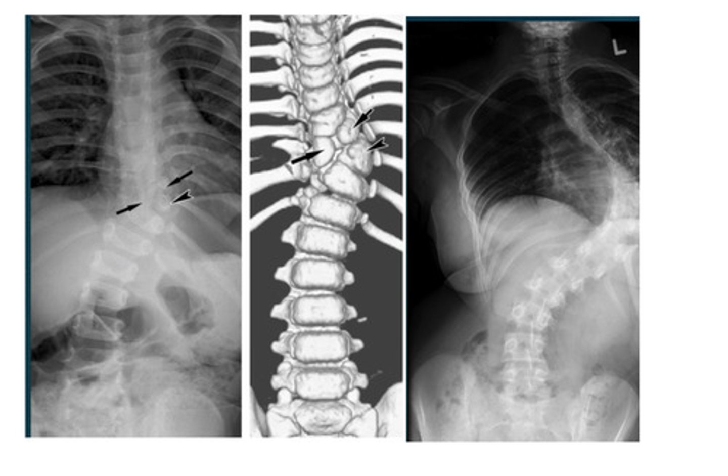 <p>What type of scoliosis is this?</p>