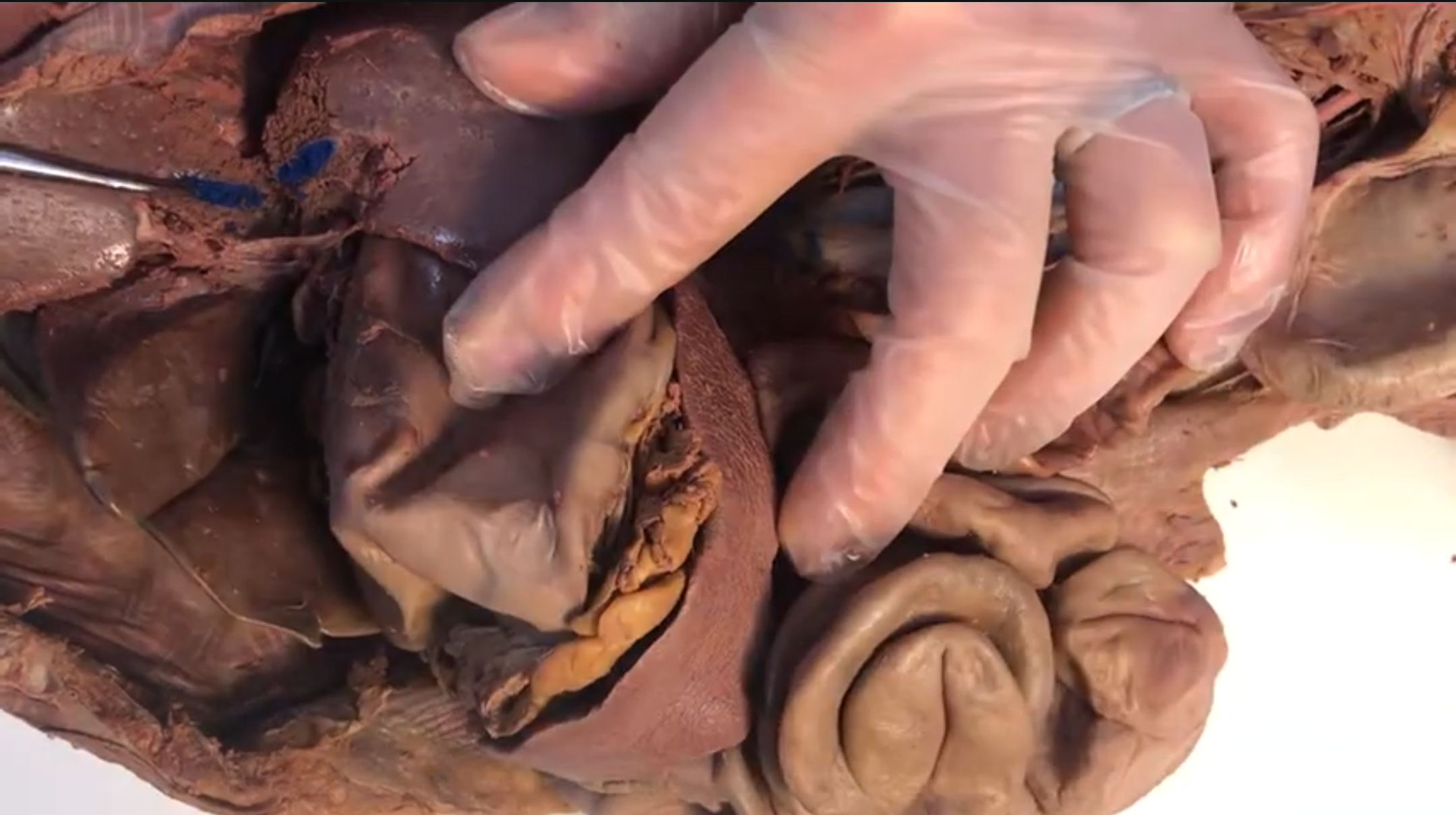 <p>What vein is this</p>