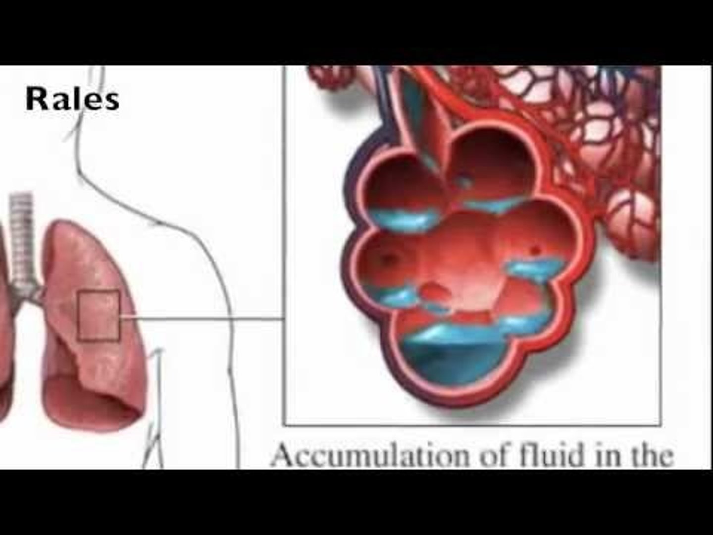 <p>Short and intermittent clicking, rattling, or popping sounds heard during inhalation when air is forced through an airway narrowed by fluid.</p>