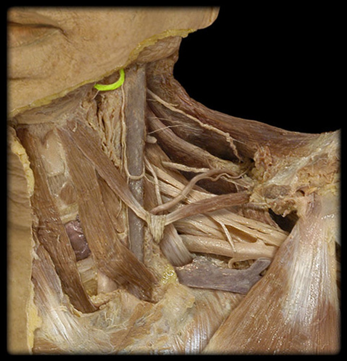 <p>no photo depicting this well. what is under the lingual n?</p>