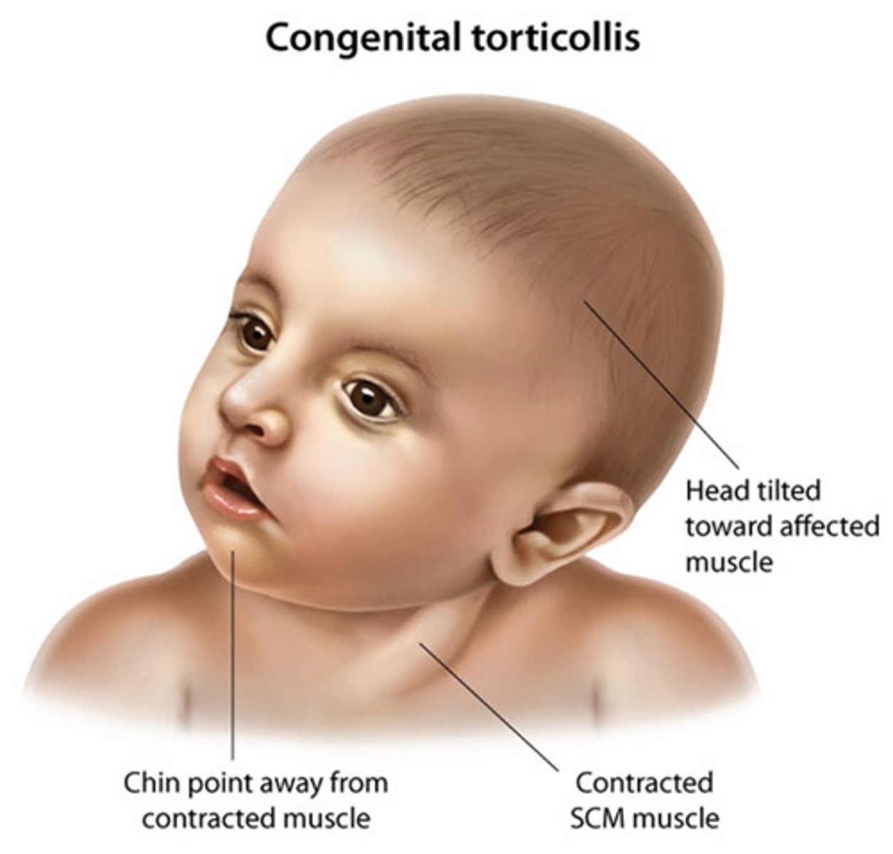 <p>head tilted toward the affected side/rotate toward the unaffected side, SCM lump (contracture that causes pain and dizziness), cranial/facial asymmetry</p>