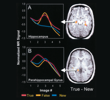 <p>higher; there is still some activity in the same regions when we recall them unsuccessfully, just less of it</p><p>prefrontal activations tend to be material specific with verbal information activating the left and visual information the right</p><ul><li><p>hippocampus doesn’t differentiate between what you think you saw and what you actually saw, but shows a difference in activation for new items</p></li><li><p>parahippocampal gyrus surrounds the hippocampus and it accurately distinguish between old and new items</p></li></ul><p></p><p></p>