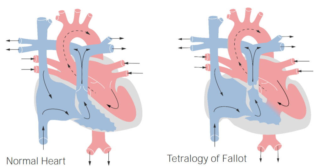<ul><li><p>Fallots tetrad är en medfödd hjärtdefekt som orsakar cyanos (blåaktig hud). Most common cyanotic CHD:</p></li><li><p>Består av fyra delar: hål i hjärtat, förträngd blodbana till lungorna, aorta som täcker båda kamrar och tjockare högerkammare.</p></li><li><p>Blodet får inte tillräckligt med syre, vilket ger cyanos.</p></li><li><p>Syrgas hjälper dåligt eftersom blodet inte kommer till lungorna.</p></li></ul><p></p>