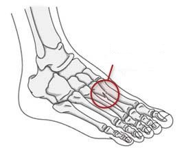 inflamed periosteum, possible hairline fractures, tiny cracks
