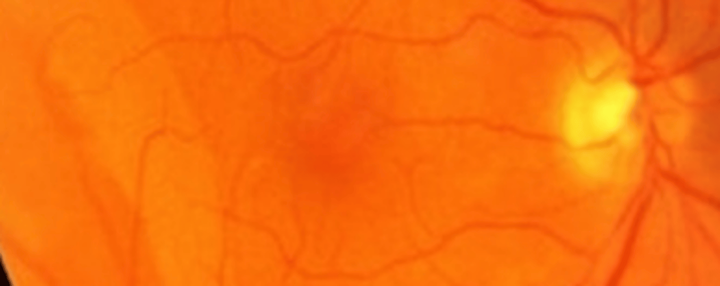 <p>retinoschisis that is more common and believed to be caused by advanced cystoid degeneration. Remains anterior to the equator, has a deep split into the retina versus bullous retinoschisis, and is usually not associated with retinal holes.</p>
