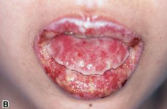 <p>severe pemphigus-like lesions that can occur in patients with cancer, leading to a range of autoimmune symptoms. </p>