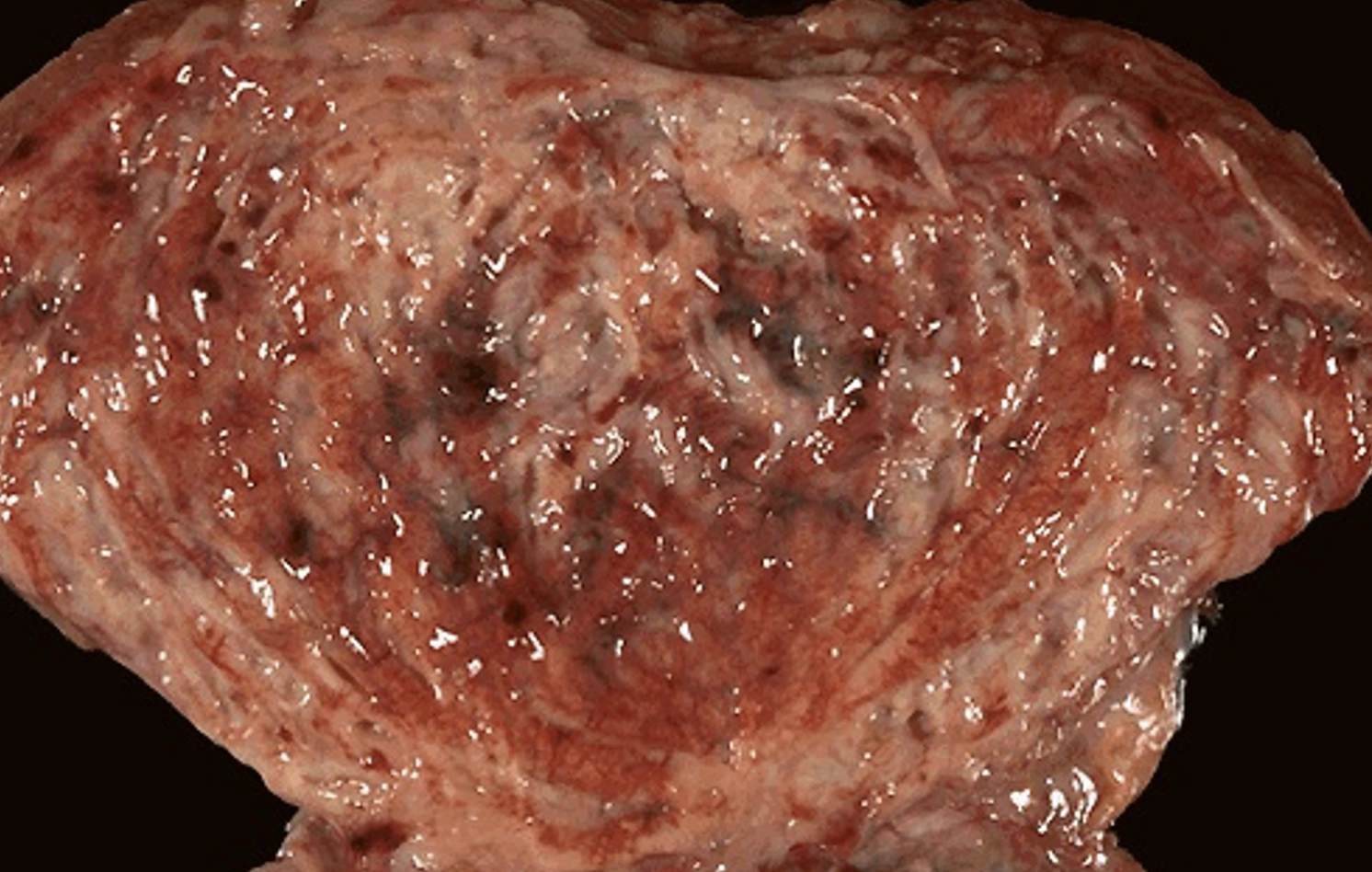 <p>What pathology is shown from this image?</p>