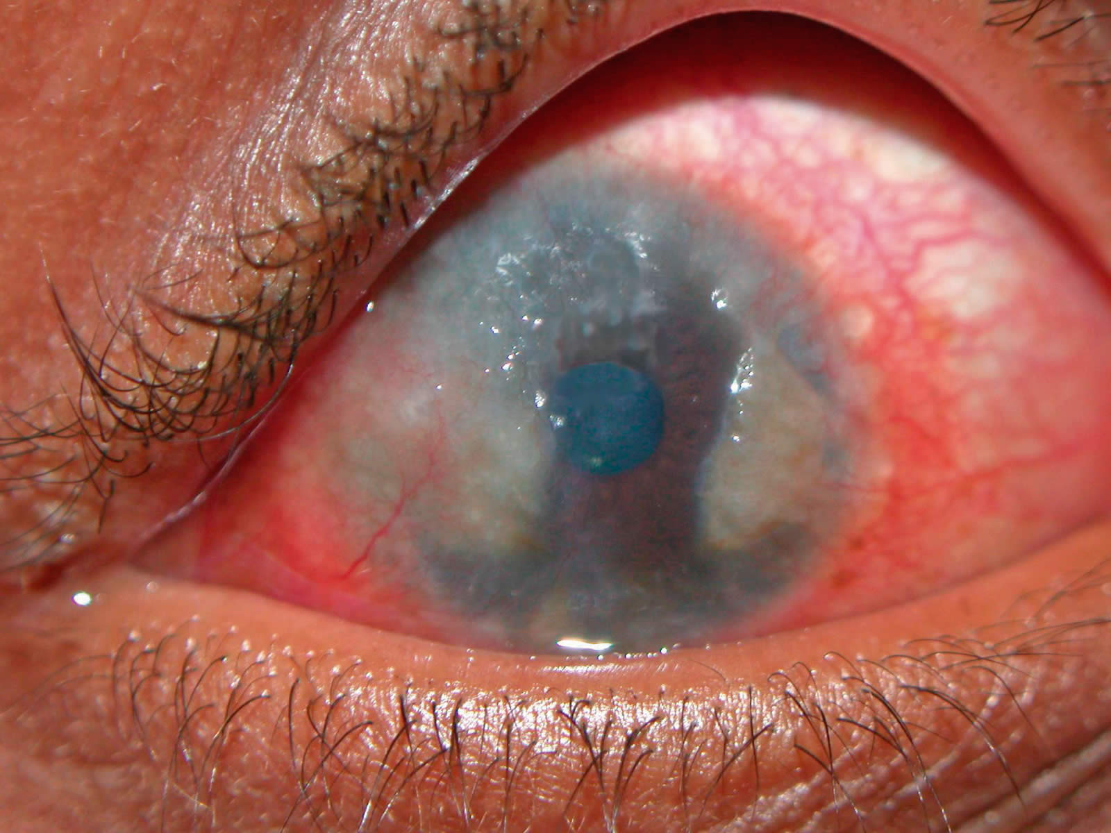 <ul><li><p><span><strong>Referred to Ophthalmologist due to sight threatening nature</strong></span></p></li><li><p><span>Corneal involvement - </span><span style="color: red"><strong>emergency</strong></span></p></li><li><p><span>No corneal involvement - </span><span style="color: blue"><strong><u>see within 2/52</u></strong></span><span><strong><u> - semi urgent</u></strong></span></p></li></ul><p></p>