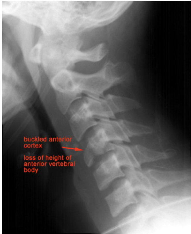 <p>Fracture of C3-C7: Wedge Fx</p><ul><li><p>MOI:</p><ul><li><p>2</p></li></ul></li><li><p>Stable or Unstable Fx?</p></li></ul><p></p><p></p>