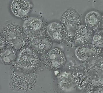 <p>Glitter cell (swollen WBC with granules)</p>