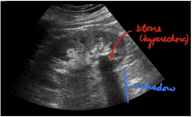 <p>Minimize radiation exposure (pregnant, pediatric)</p><p>Hyperechoic stones + Shadowing</p>