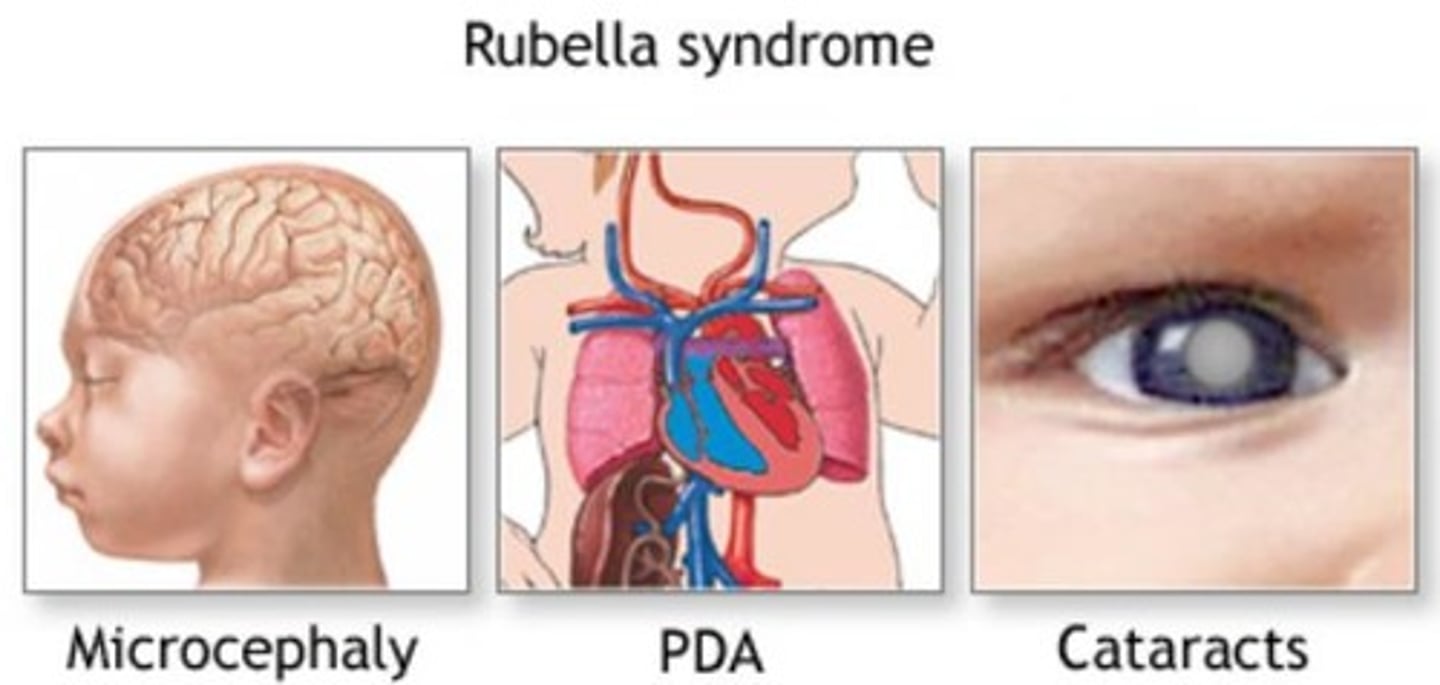 <p>Classic triad:</p><p>1. congenital cataracts (white pupils)</p><p>2. sensory-neural deafness</p><p>3. Patent ductus arteriosus (could be pulmonary artery stenosis as well)</p><p>Could potentially also result in microcephaly and mental retardation</p><p>non-pregnant females should be vaccinated with the live MMR vaccine prior to pregnancy.</p><p>rubella is a teratogent</p>