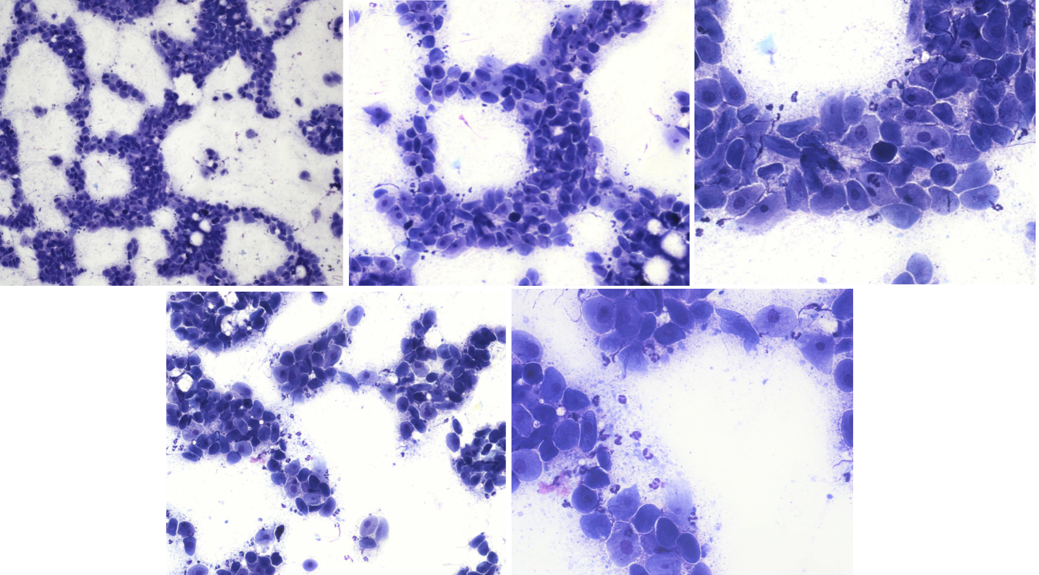 <p>Utstryk 6<br>Parabasalceller: <br>Intermediärceller: <br>Superficialceller: <br>Erytrocyter: <br>Neutrofiler:</p><p>Stadium:</p>