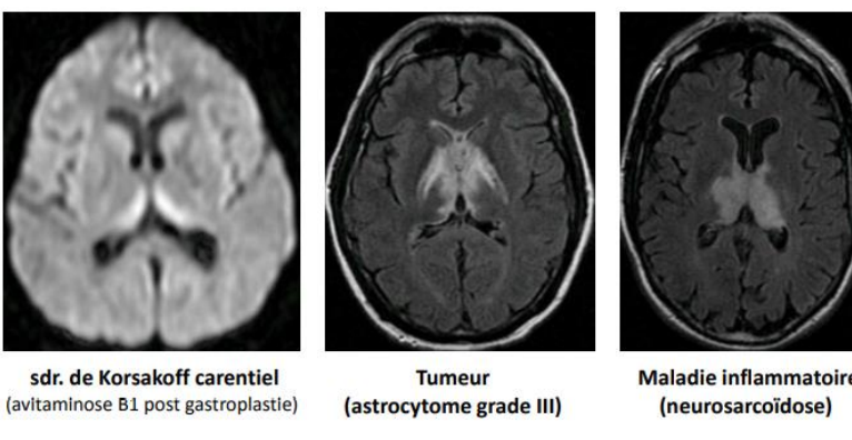 il s’agit d’une atteinte du thalamus antérieur.
Syndrome de Korsakoff : manque de la vitamine B1 (patients alcooliques, dénutris) qui entraine qui dégénérescence des noyaux du thalamus.
Autre étiologies : syndrome de Korsakoff éthylique : à tort attribué à l’atteinte des corps mamillaires, souvent es lésions ne sont pas visibles car installation progressive. AVC bilatéral a. cérébrale postérieure, hématomes thalamiques…