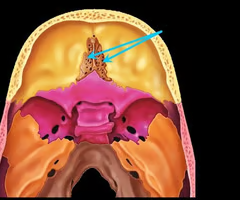 <p>cribriform plate of ethmoid bone</p>