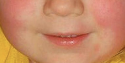 <p><em>Streptococcus pyogenes</em> Infection</p><p>Complication of strep throat caused by erythrogenic toxin; causes sandpaper-like rash and strawberry tongue.</p><p>treated with penicillin or cephalexin</p>