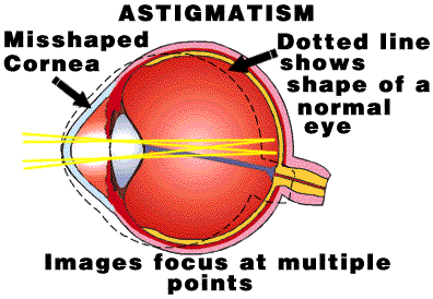 Astigmatism
