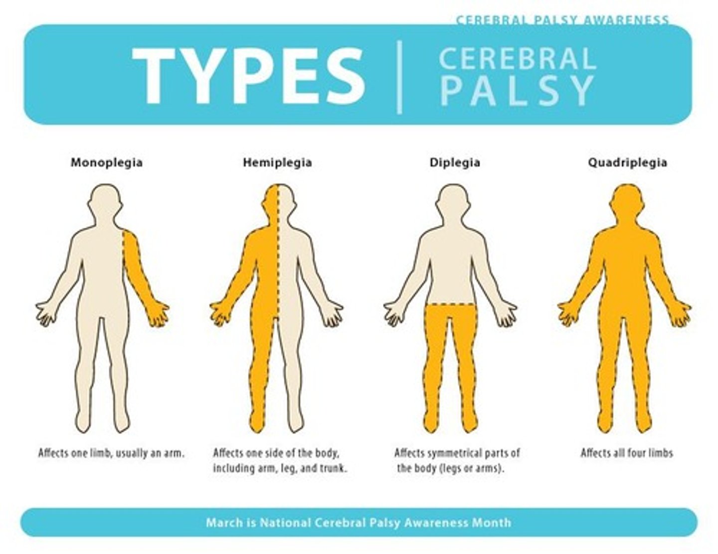 <p>Cerebral palsy predominantly affecting one side of the body.</p>