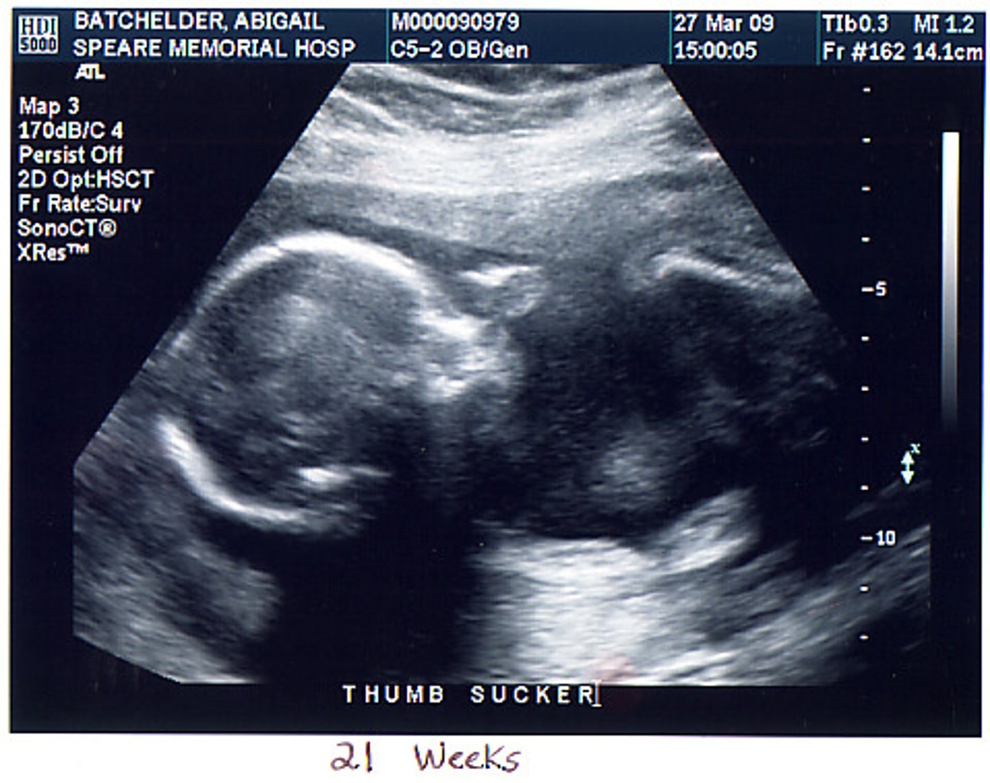 <p>High-frequency sound waves used to create an image of a developing fetus and can check the size, location, and actions of organs and blood flow through blood vessels</p>