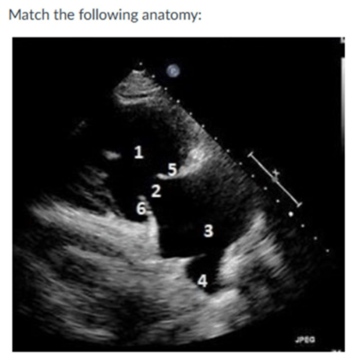 <p>1. RV</p><p>2. TV</p><p>3. RA</p><p>4. IVC</p><p>5. Anterior leaflet</p><p>6. posterior leaflet</p>