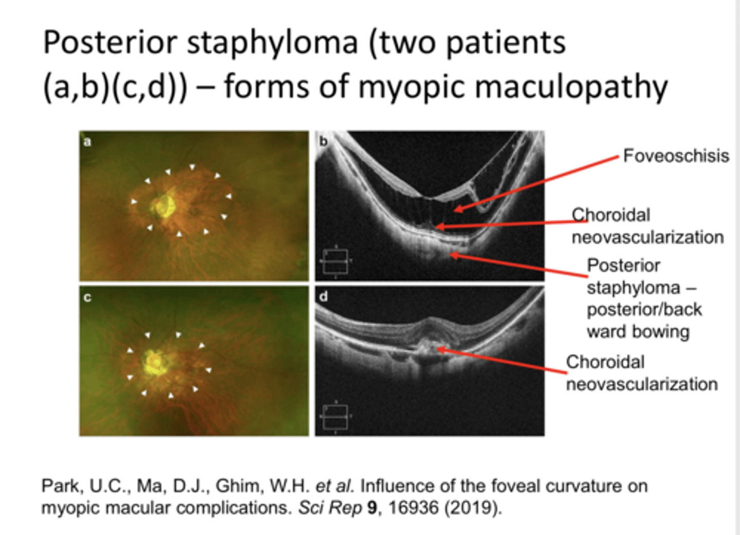<p>What is an eventual consequence of a posterior staphyloma?</p>
