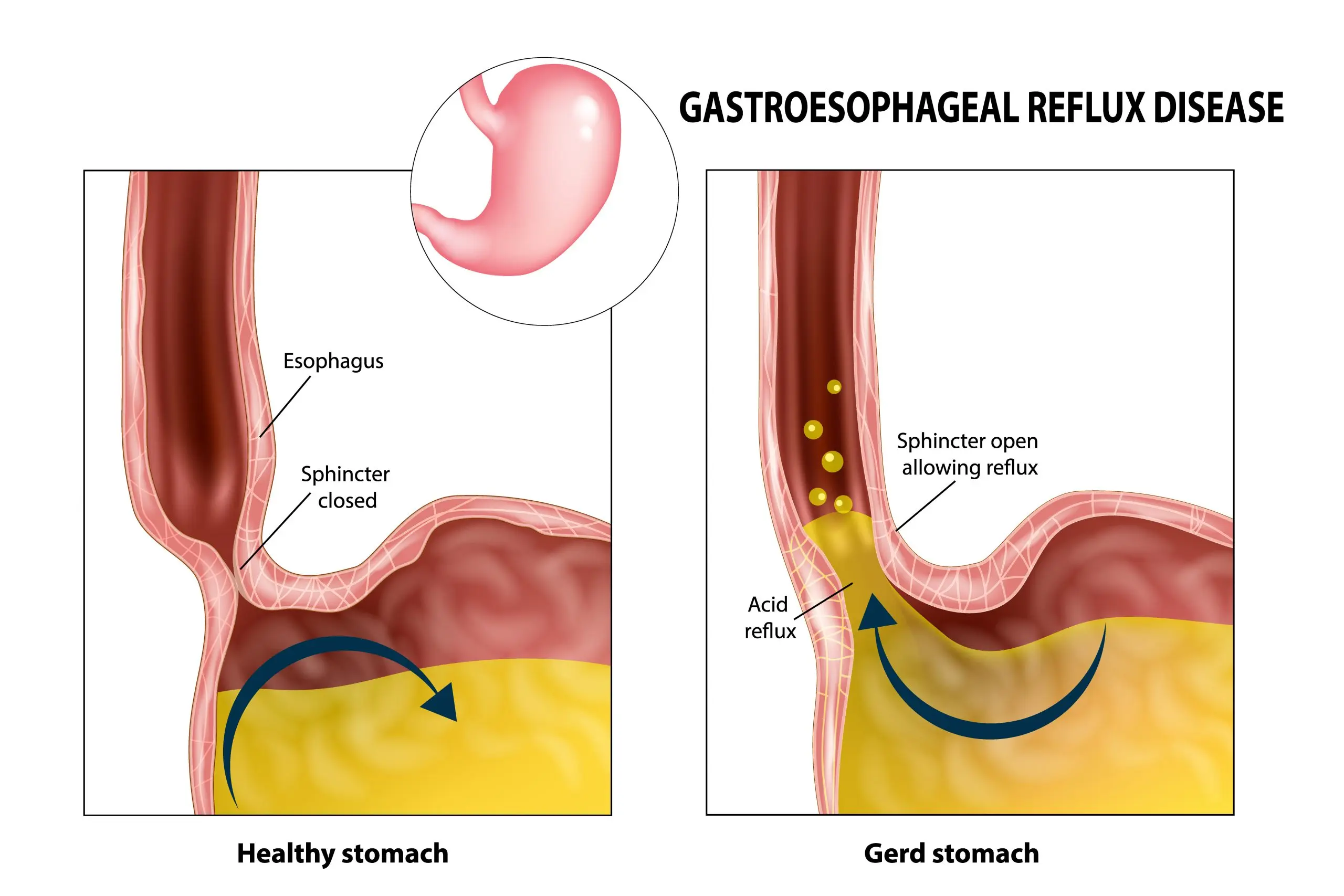 <ul><li><p>Condition in which contents of the stomach move up through the esophagus, irritating the lining</p></li><li><p>Chronic disease</p></li><li><p>Symptoms:</p><ul><li><p>heartburn after eating, worsens while laying down</p></li><li><p>backwash of food</p></li><li><p>dysphagia (difficulty swallowing) </p></li><li><p>sensation of lump in the throat</p></li></ul></li></ul>