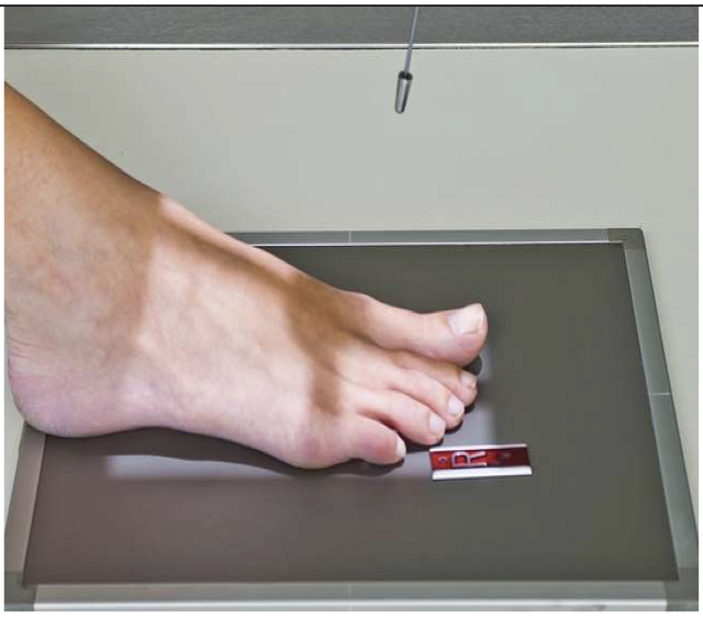 <p>Patient Position </p><ul><li><p class="p1"><span style="line-height: normal;"><span>&nbsp;</span></span>Sitting or lying on X-ray table</p></li><li><p class="p1"><span style="line-height: normal;"><span>&nbsp;</span></span>Leg of interest on table</p></li></ul><p class="p1"></p><p class="p1">Part Position</p><ul><li><p class="p1"><span style="line-height: normal;"><span>&nbsp;</span></span>Plantar surface of foot on IR</p></li><li><p class="p1"><span style="line-height: normal;"><span>&nbsp;</span></span>No rotation of foot</p></li><li><p class="p1"><span style="line-height: normal;"><span>&nbsp;</span></span>Metatarsal of interest centered to IR</p></li></ul><p class="p1"></p><p class="p1"> CR</p><ul><li><p class="p1"><span style="line-height: normal;"><span>&nbsp;</span></span>10-15<span style="line-height: normal;"><span>◦ </span></span>toward calcaneus</p></li><li><p class="p1">Centered to MTP of interest</p></li></ul><p class="p1"></p><p class="p1"><span style="font-size: 1.6rem;"><span>Collimation</span></span><span style="line-height: normal; font-size: 1.6rem;"><span>&nbsp;</span></span></p><ul><li><p class="p1"><span style="font-size: 1.6rem;"><span>Include entire&nbsp;</span></span>toe and at least ½ of metatarsal</p></li></ul><p></p>